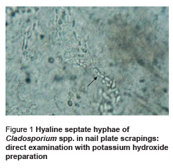 Figure 1 Hyaline septate hyphae of Cladosporium spp. in nail plate scrapings: direct examination with potassium hydroxide preparation