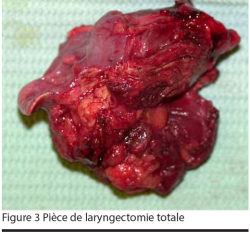 Figure 3 Pièce de laryngectomie totale