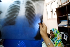 Photo of a chest X-ray of a TB suspect being examined