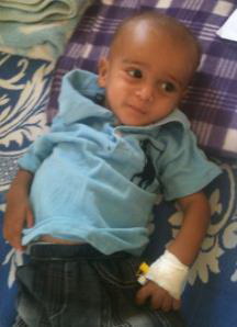 Malnourished_child