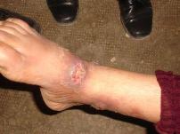 Leishmaniasis ankle lesion